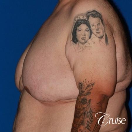 severe gynecomastia with free nipple graft on adult - Before Image 2