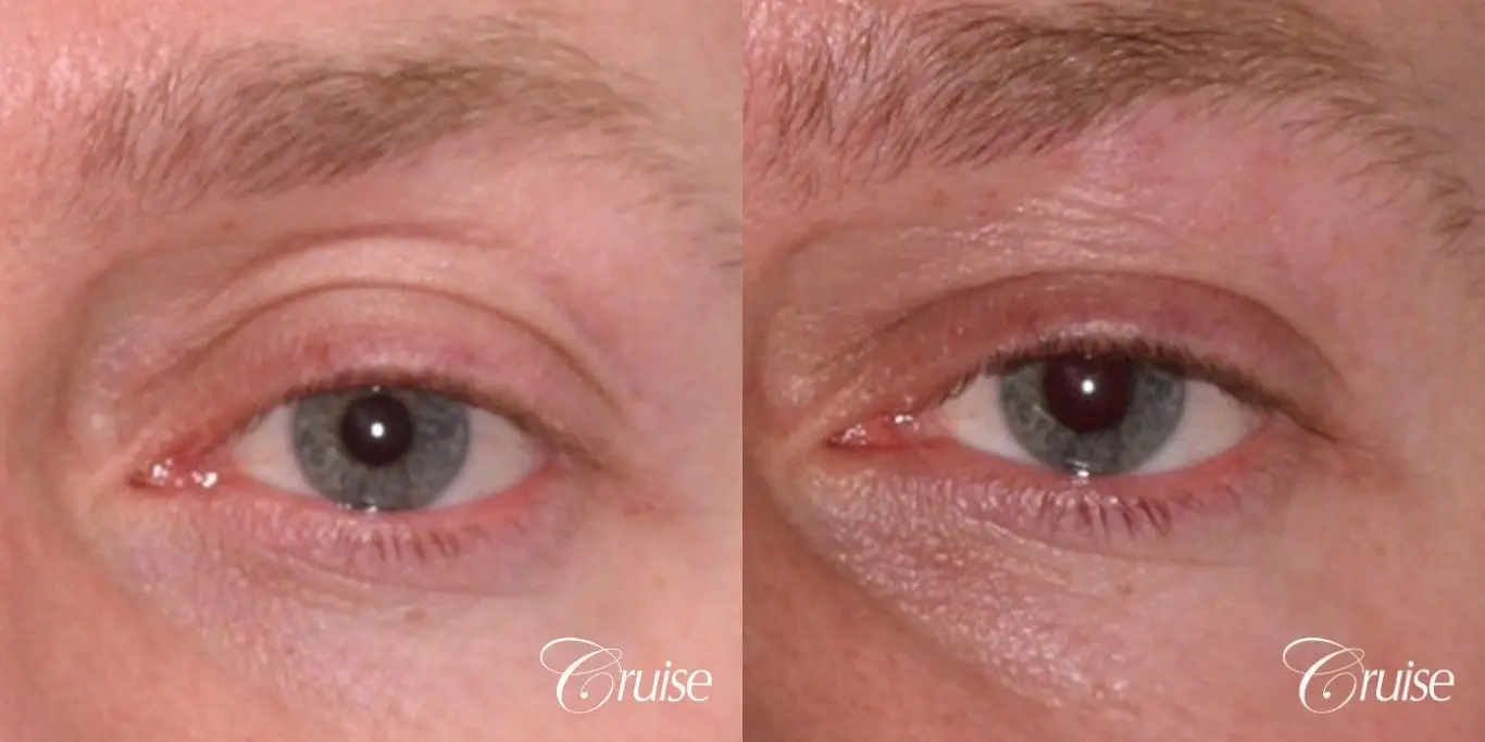 male soft tissue filler Juvaderm - Before and After