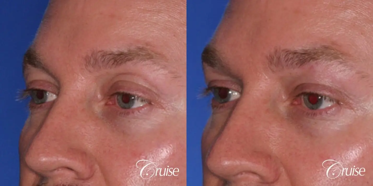 male soft tissue filler Juvaderm - Before and After 2