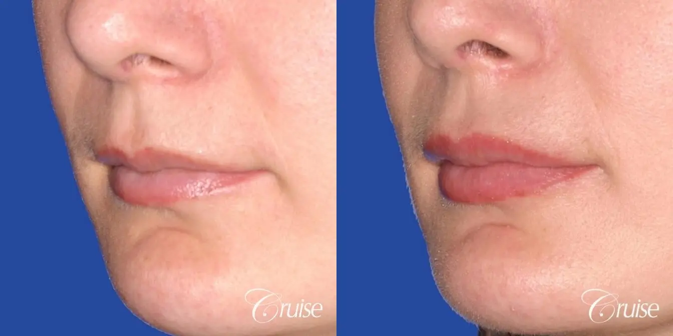 best before and after of lip filler - Before and After 2