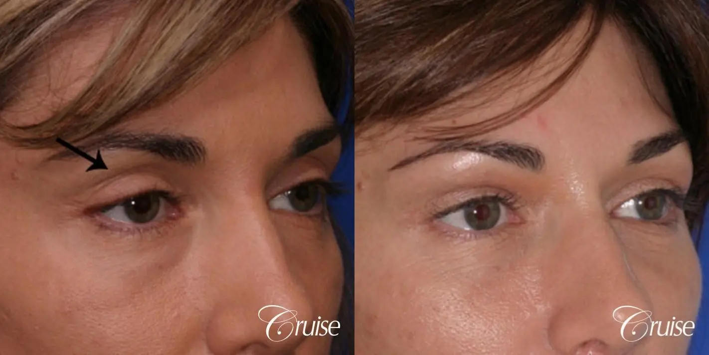 best soft tissue filler using Juvaderm - Before and After 3