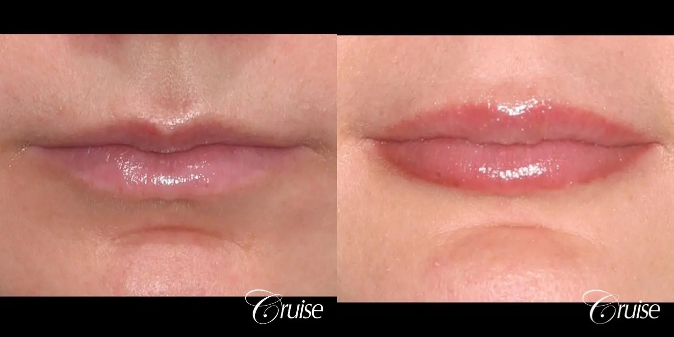 best before and after of lip filler - Before and After 1