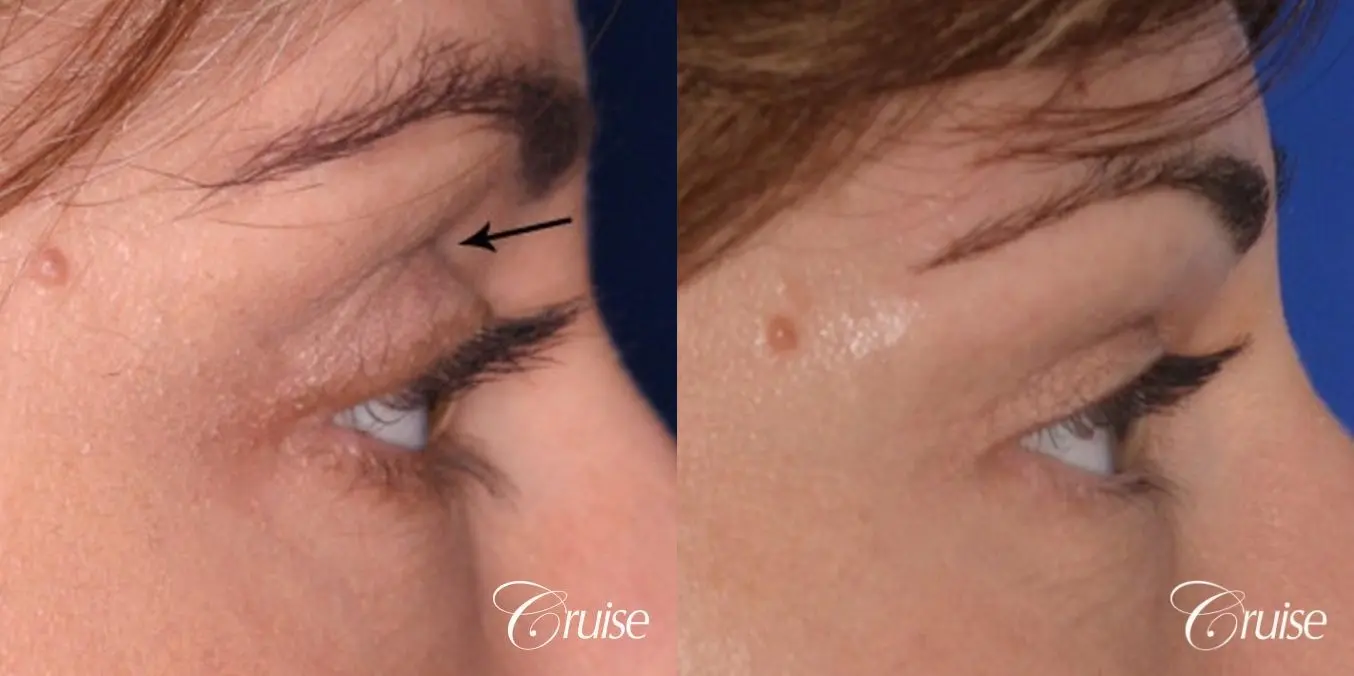 best soft tissue filler using Juvaderm - Before and After 2