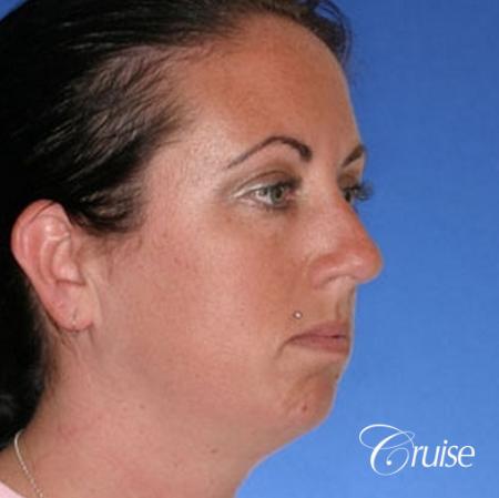 before and after photos of female chin implant - Before Image 3