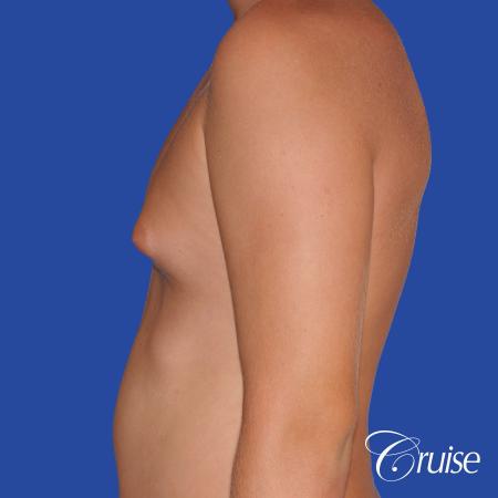 teen with pointy / puffy nipples get gynecomastia surgery - Before Image 2