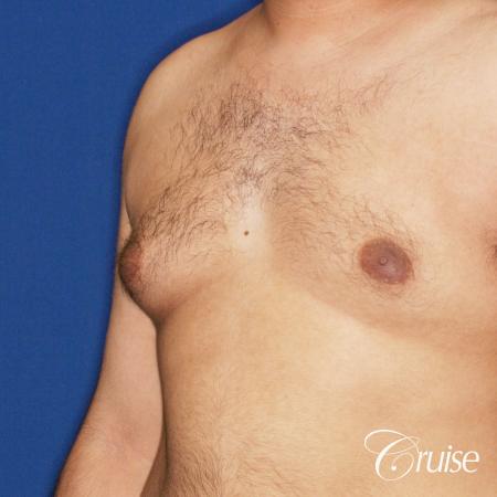 best scar on 32 gynecomastia patient - Before Image 2