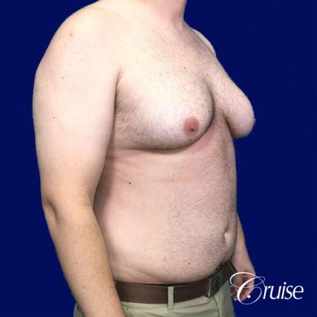 Severe Gynecomastia- Free nipple Graft - Before and After Image 3
