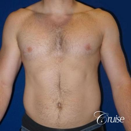 Dr. Cruise gynecomastia surgery photos - After Image 1