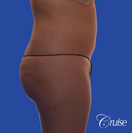 best pictures of liposuction with plastic surgeon in Newport Beach - Before and After Image 5