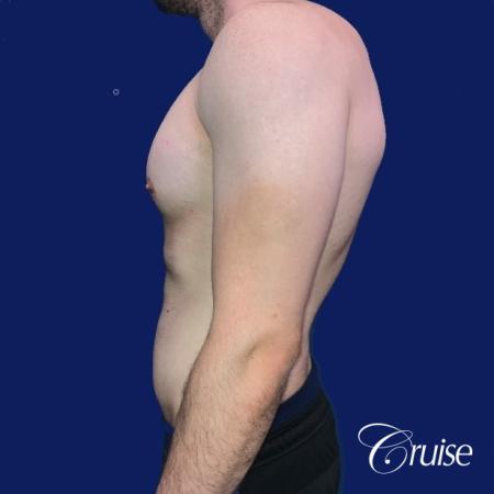 Moderate Gynecomastia -Areola Incision - Before Image 2
