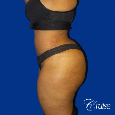 Best Tummy Tuck surgeons Newport Beach - After Image 3