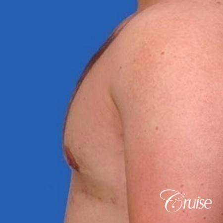 mild gynecomastia with puffy nipple on adult - After Image 2