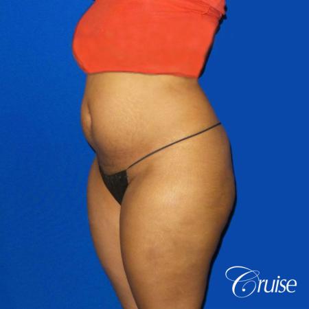 Best Tummy Tuck surgeons Newport Beach - Before Image 2
