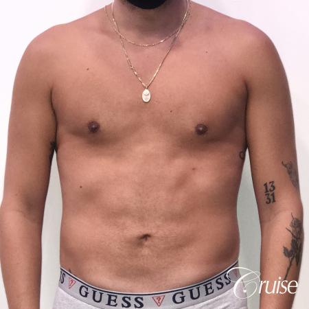gynecomastia correction orange county - After Image 1