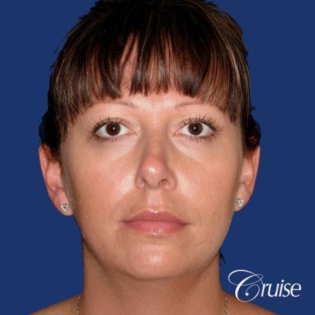 best before and after of chin augmentation medium implant - Before Image 1