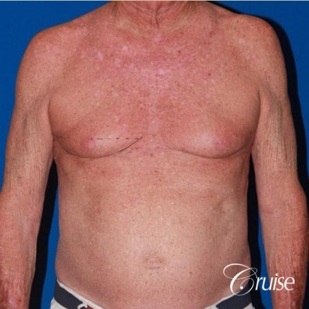 free nipple graft gynecomastia on old man - Before Image 1