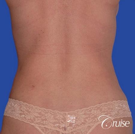 low mini tummy tuck with D cup breast augmentation - After Image 3