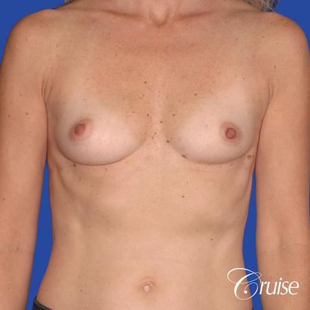 Before Image 1