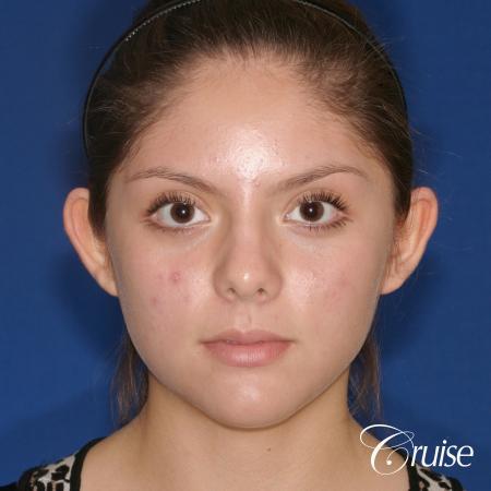 best before and after pictures of otoplasty - Before Image 1