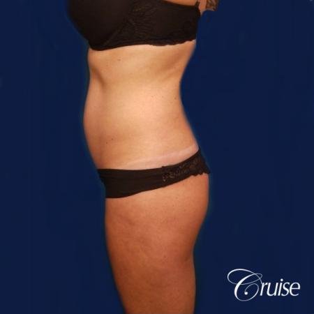 Brazilian Butt Lift Dr. Cruise - Before Image 2