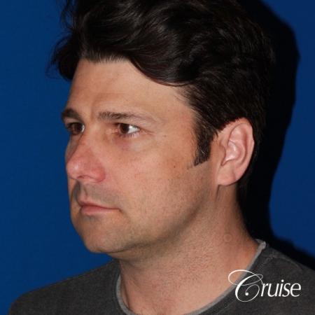 best medium terino square implant before and after pictures - Before Image 3