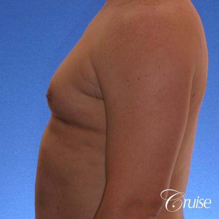 male adult with gynecomastia - Before Image 2