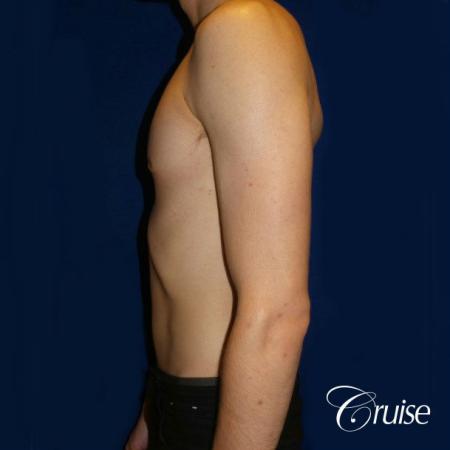Top Gynecomastia Specialist Dr. Cruise - After Image 2