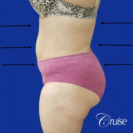 Best liposuction procedures dr cruise - After Image 2