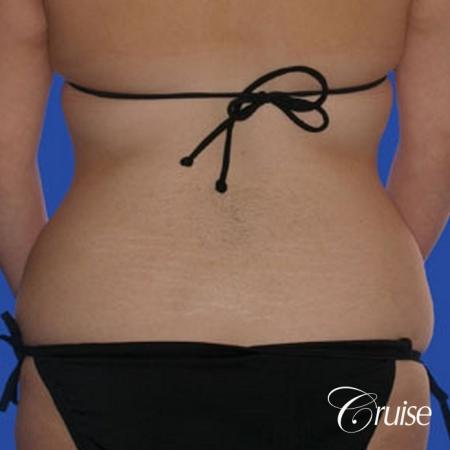 best liposuction tummy tuck - Before and After Image 3