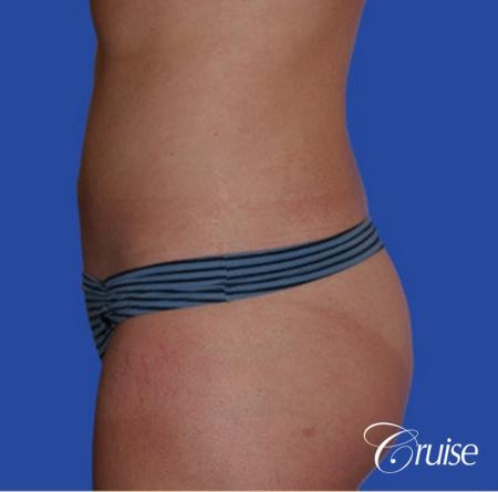 best skinny abs from liposuction abdomen and flanks - After Image 3
