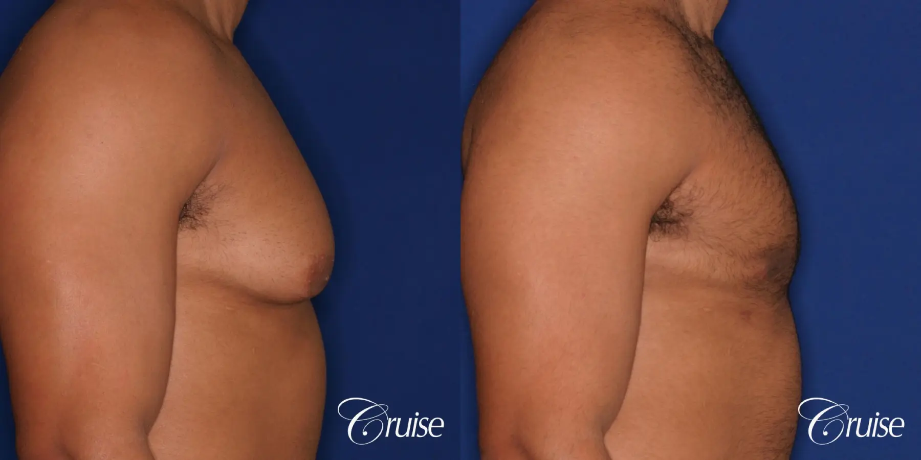 26 yo athletic patient with moderate gynecomastia - Before and After 3