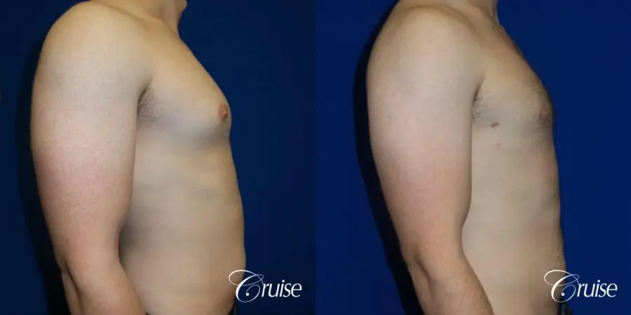 Adult gynecomastia before and after photos - Before and After 3
