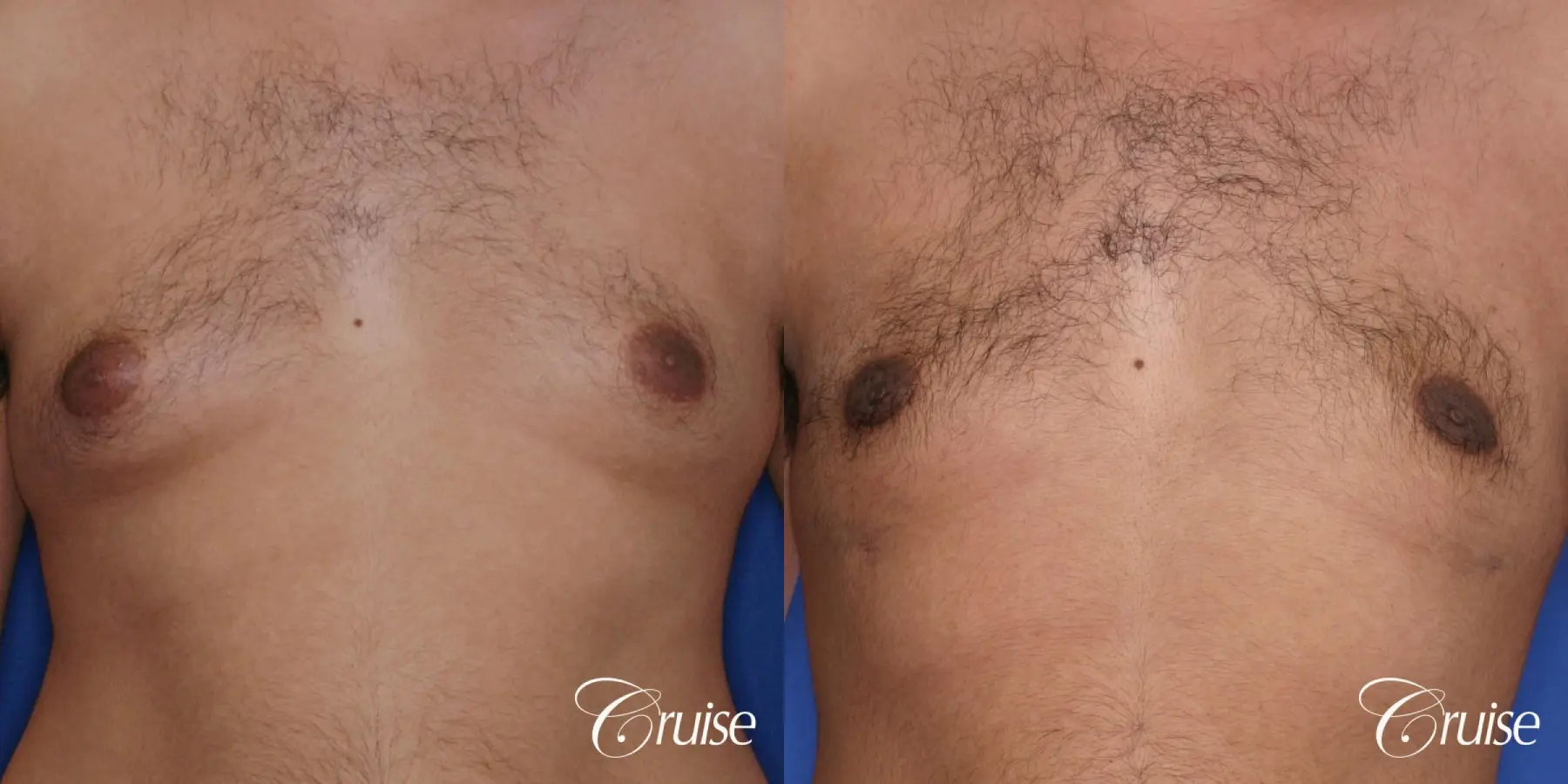 best scar on 32 gynecomastia patient - Before and After 1