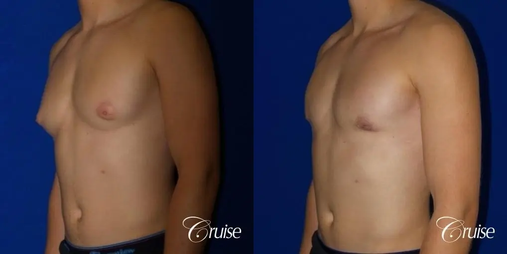 teenage gynecomastia before and afters - Before and After 4