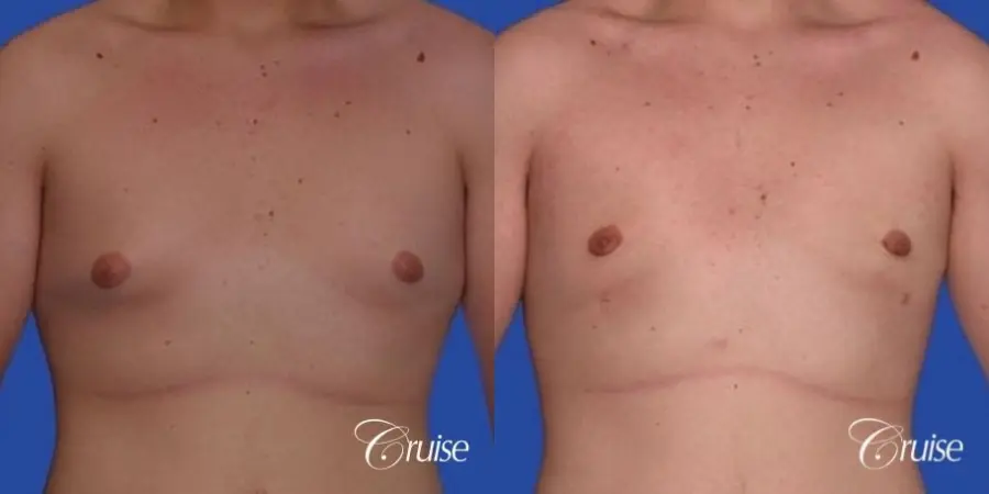 mild gynecomastia with puffy nipple from puberty - Before and After 1