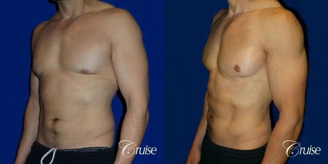 Type 3 Skin Laxity Gynecomastia with Nipple Elevation - Before and After 3