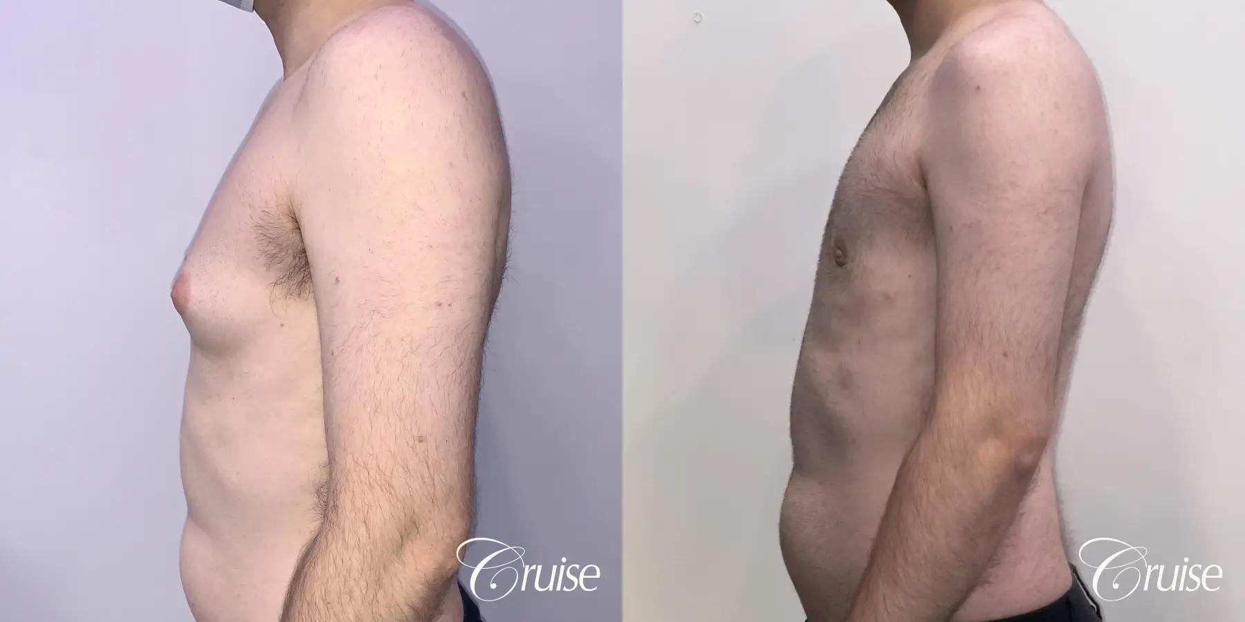 Gynecomastia: Patient 132 - Before and After 2