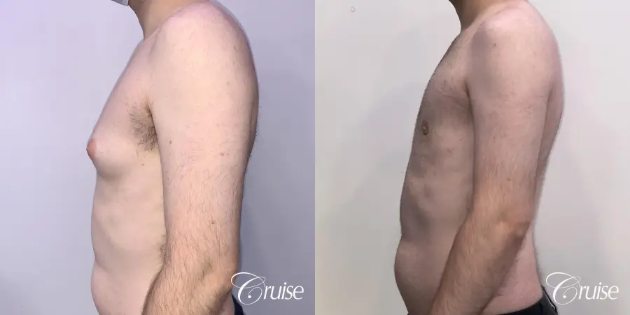 Gynecomastia: Patient 132 - Before and After 2