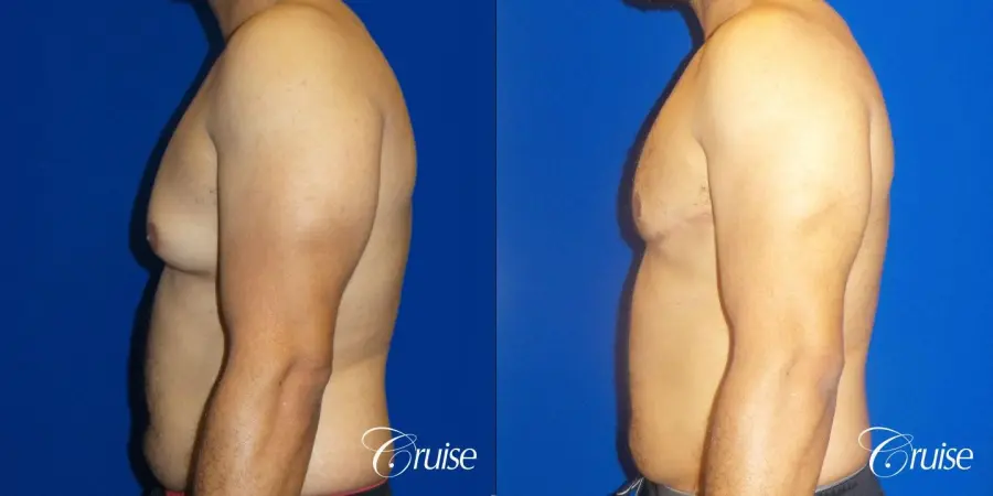 Best gynecomastia specialist in united states - Before and After 3