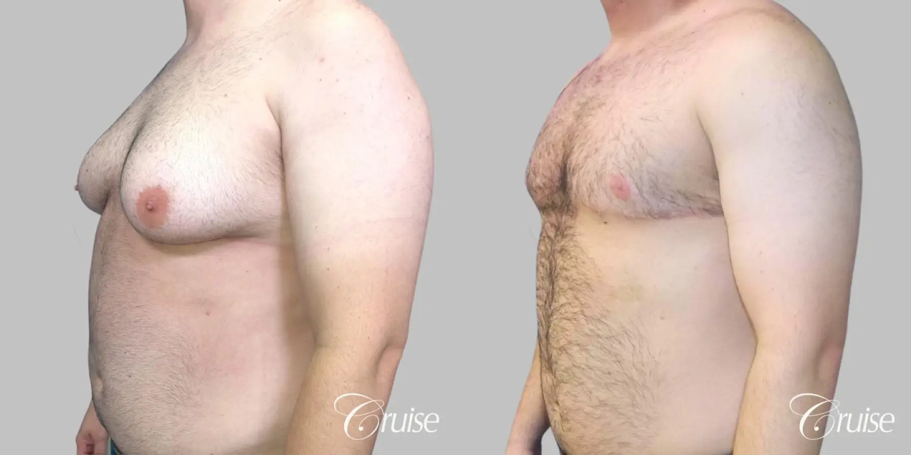 Severe Gynecomastia- Free nipple Graft - Before and After 2