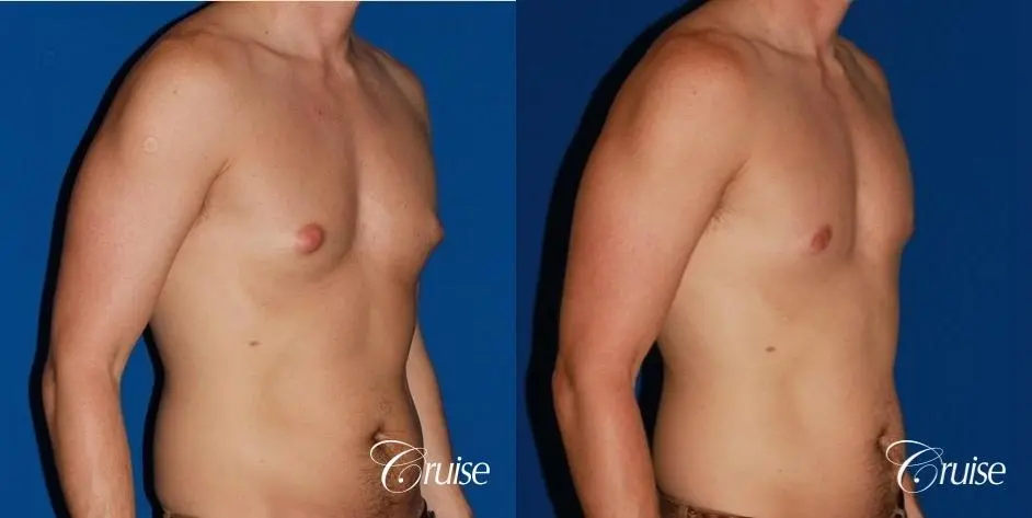 puffy nipple on low body fat - Before and After 4
