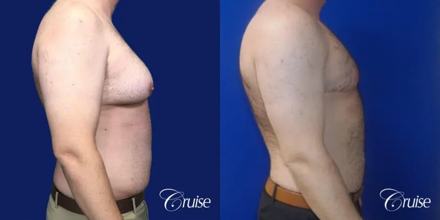 Severe Gynecomastia- Free nipple Graft - Before and After 2