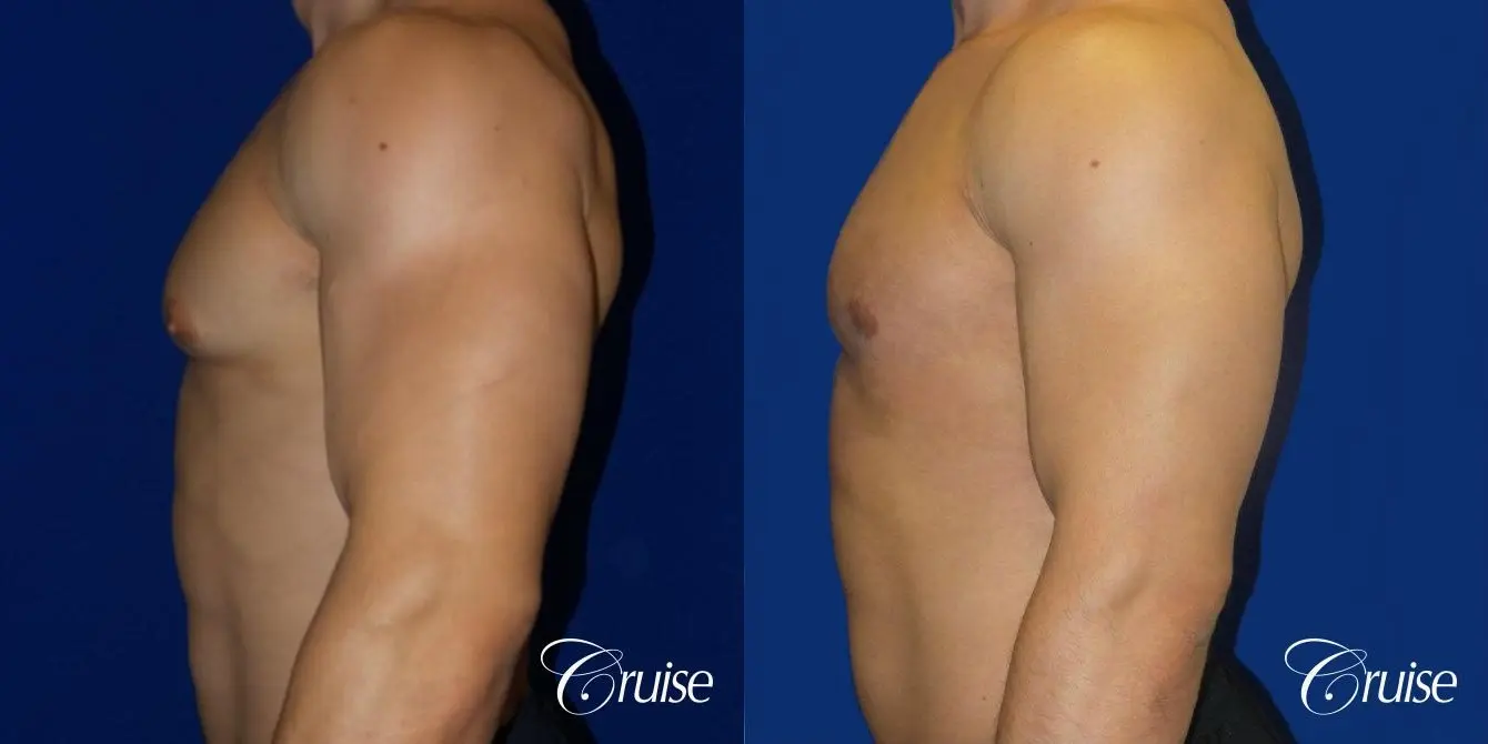 Type 1 Body Builder Puffy Nipple Correction - Before and After 3