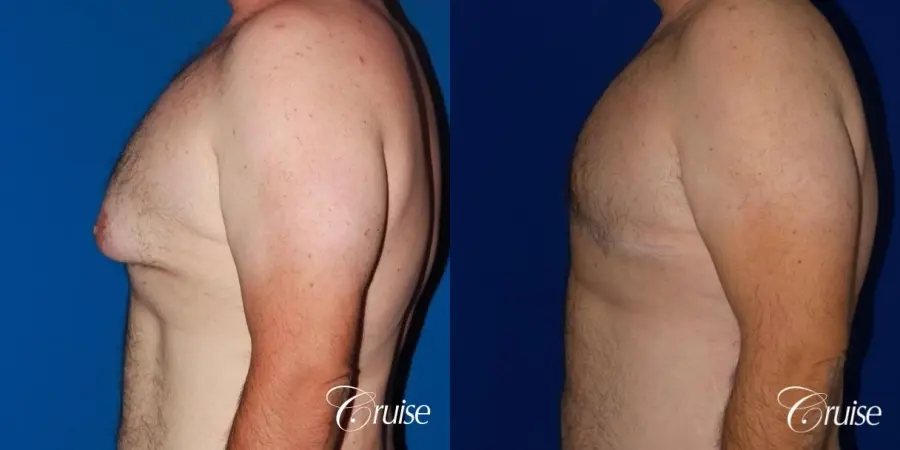 Severe Gynecomastia -Free Nipple Graft - Before and After 3