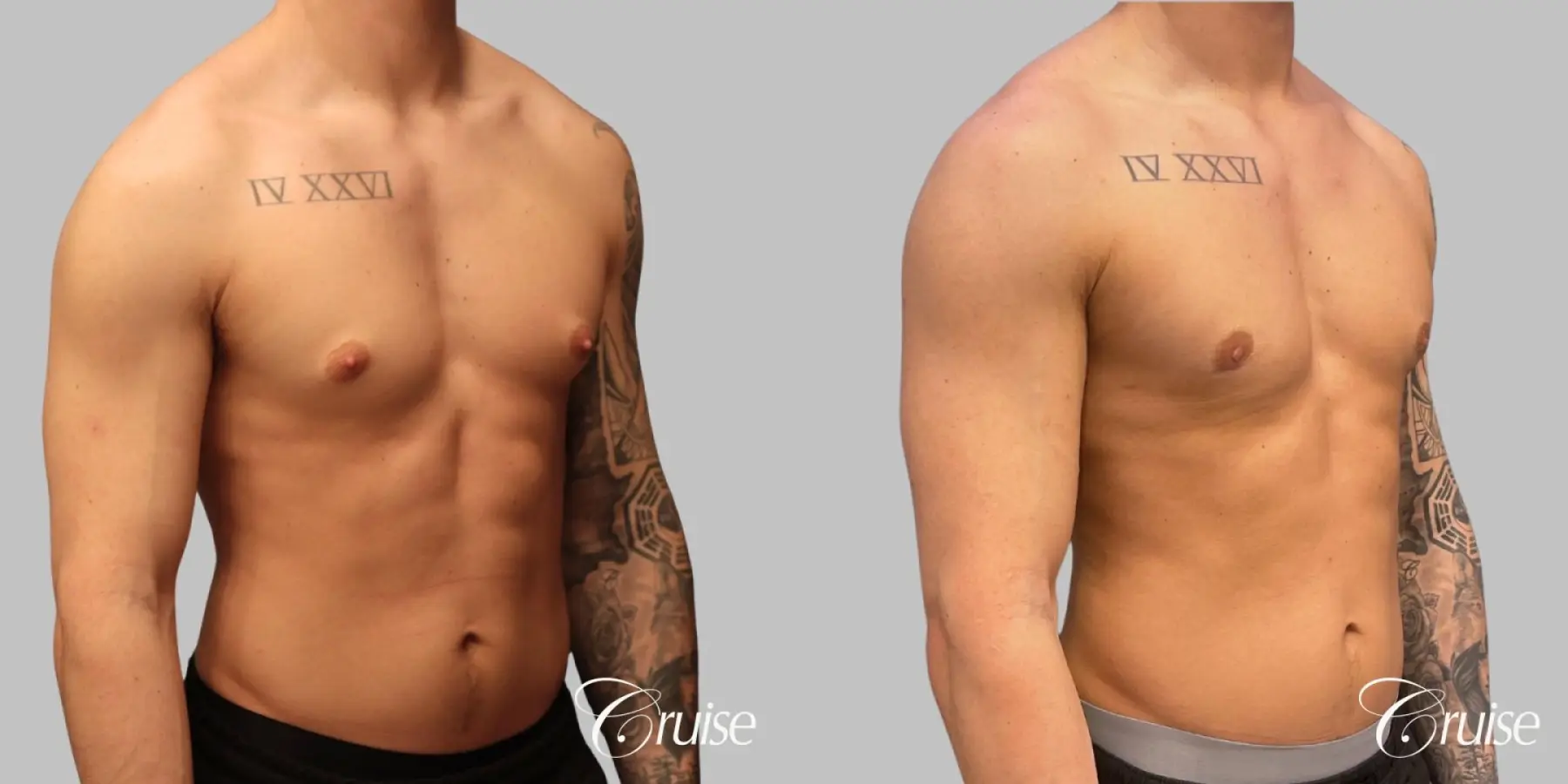 Gynecomastia Type 1 Inferior Crescent - Before and After 2