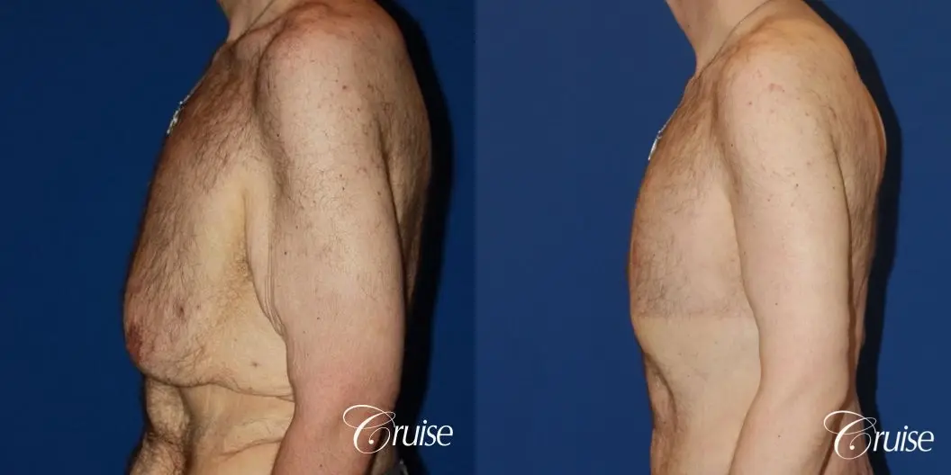 severe weight loss gynecomastia upper body lift - Before and After 3