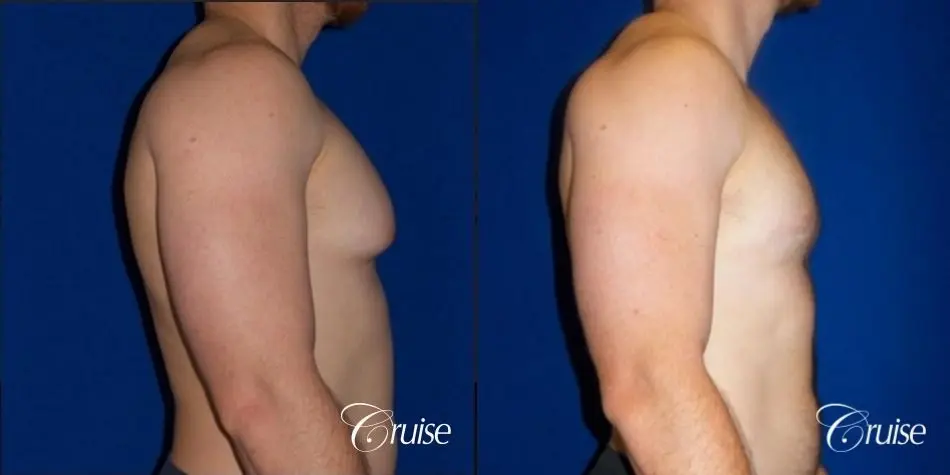 Dr. Cruise gynecomastia surgery photos - Before and After 4