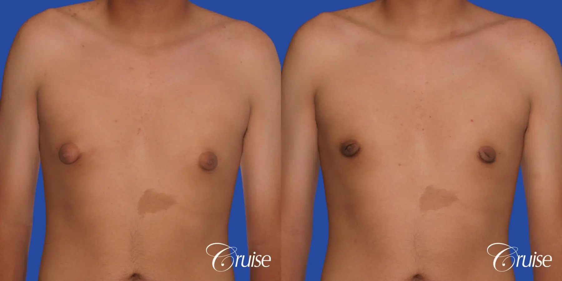 gynecomastia patient gets nipple reduction for best results - Before and After 1