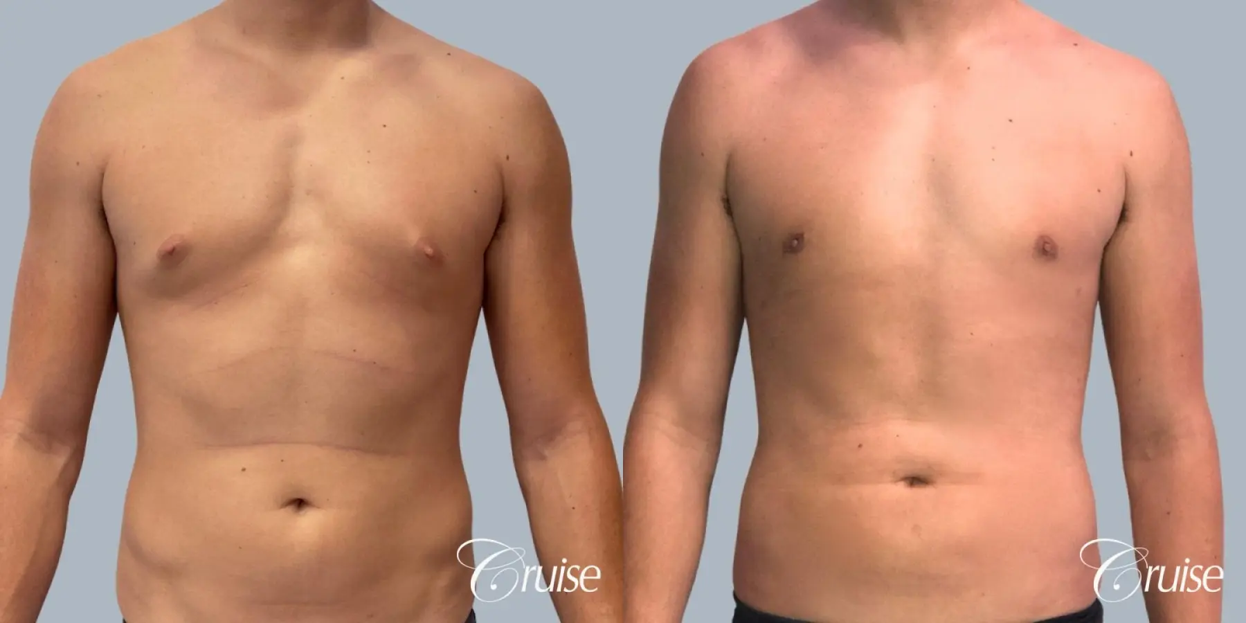 Gynecomastia: Patient 153 - Before and After 1