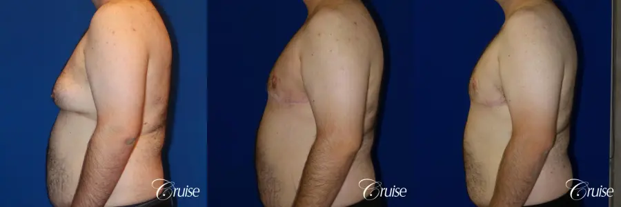 gynecomastia with free nipple graft - Before and After 3